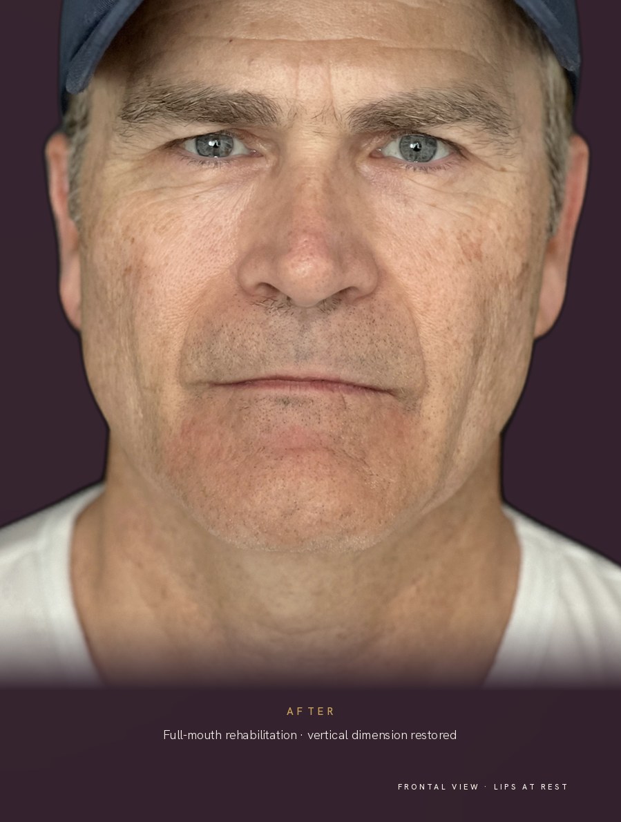 The same patient after full-mouth rehabilitation, frontal view with the lips at rest. The lower face is taller, the lips are fuller, and the fold beneath the lower lip has softened.