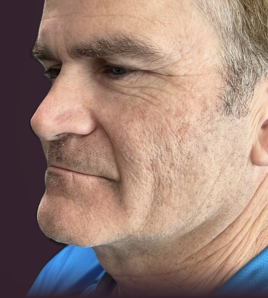 Profile view before full-mouth rehabilitation showing reduced lower facial height and a pronounced labiomental fold.