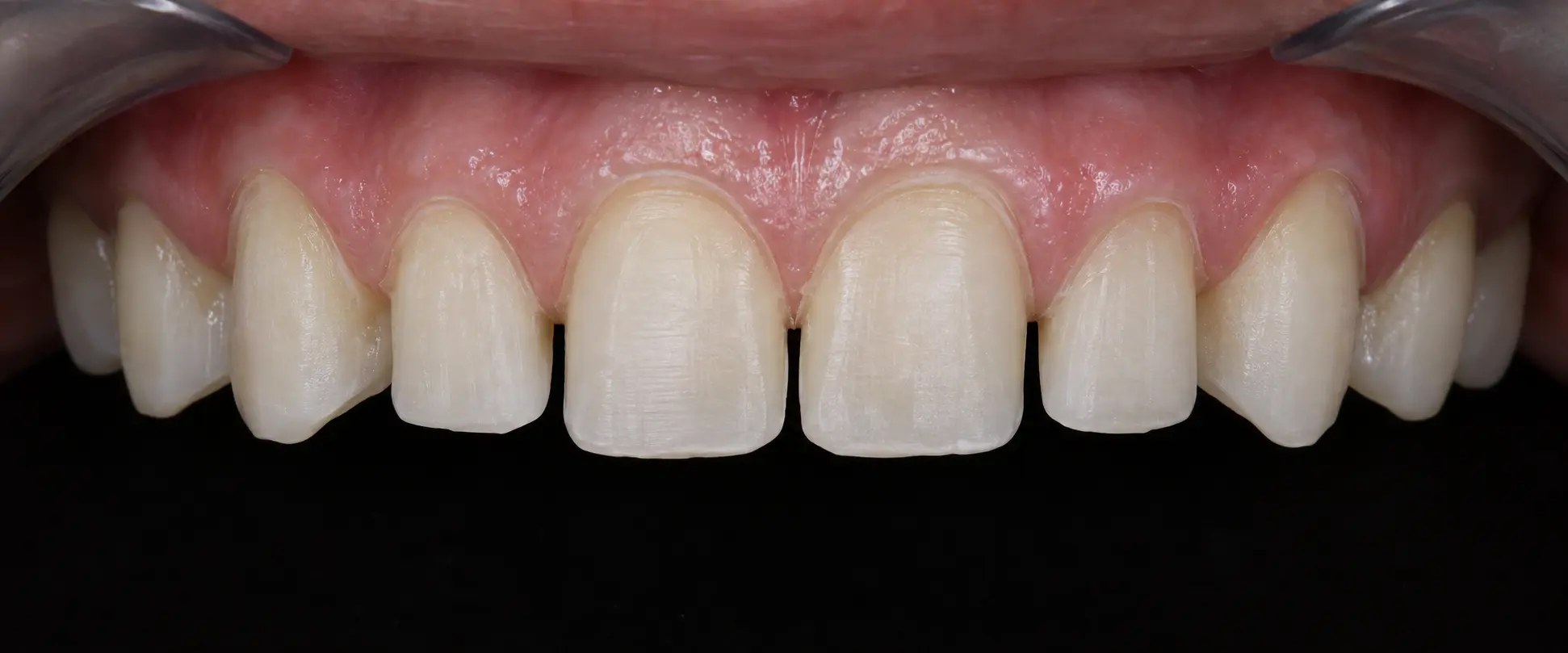 Educational illustration of conservative tooth preparation for porcelain veneers