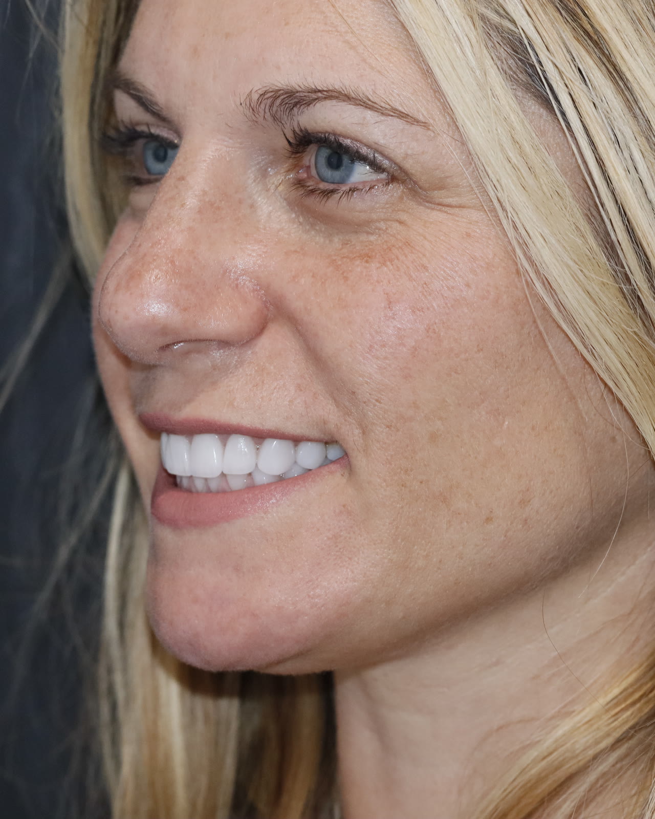 After full-mouth veneer treatment, three-quarter view facing left