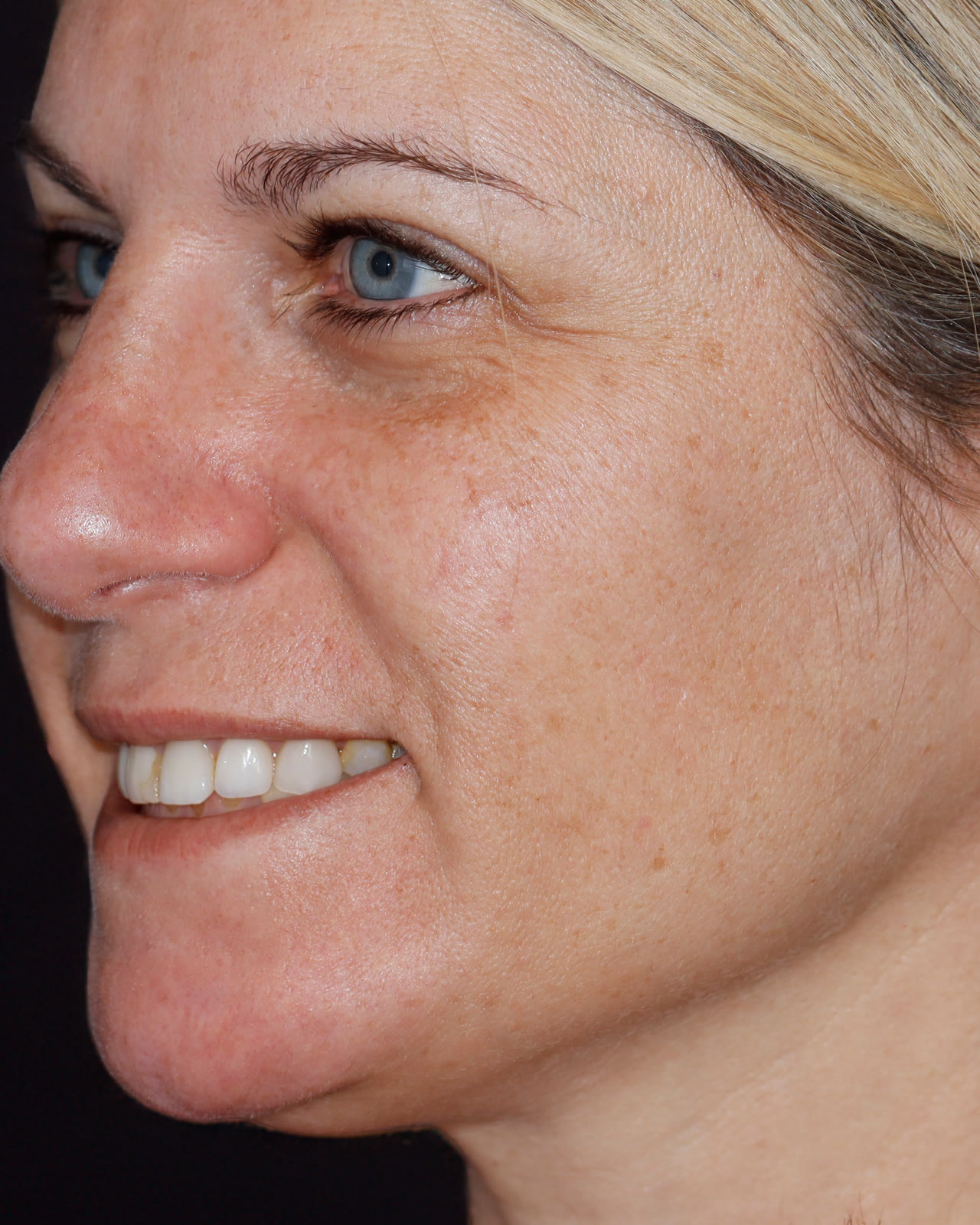 Before full-mouth veneer treatment, three-quarter view facing left
