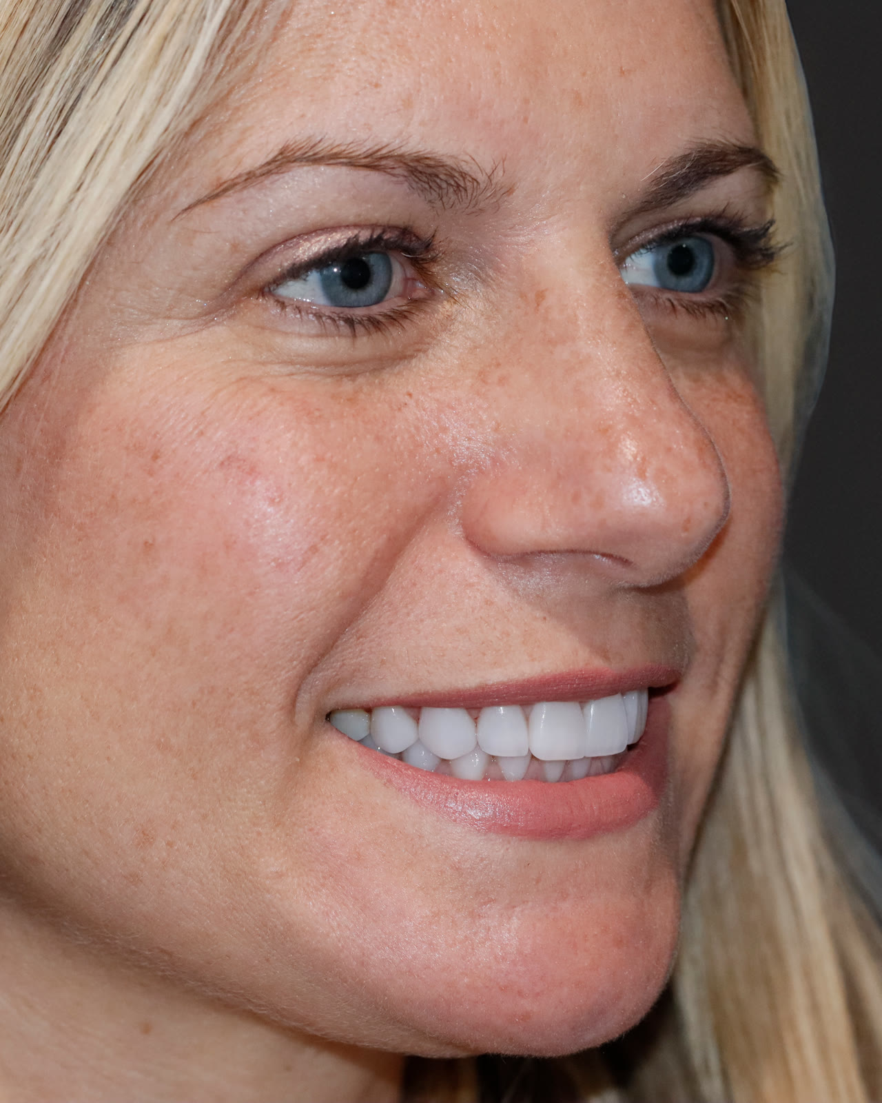 After full-mouth veneer treatment, three-quarter view facing right