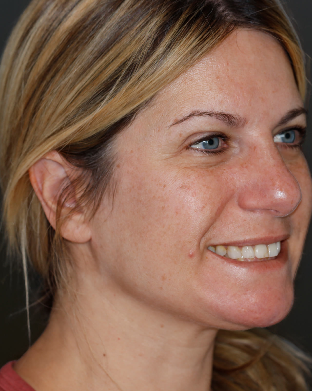 Before full-mouth veneer treatment, three-quarter view facing right