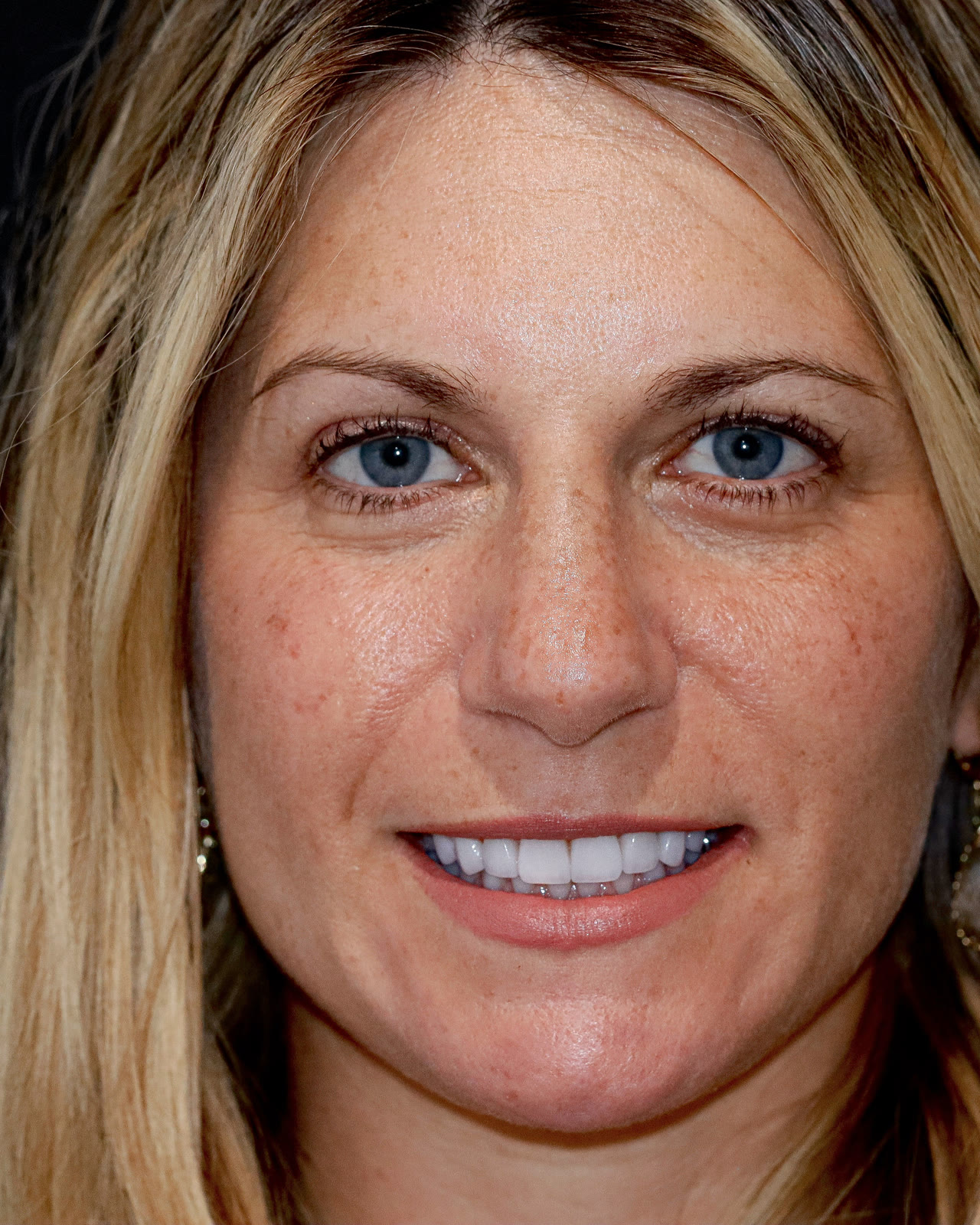 After full-mouth veneer treatment, front view
