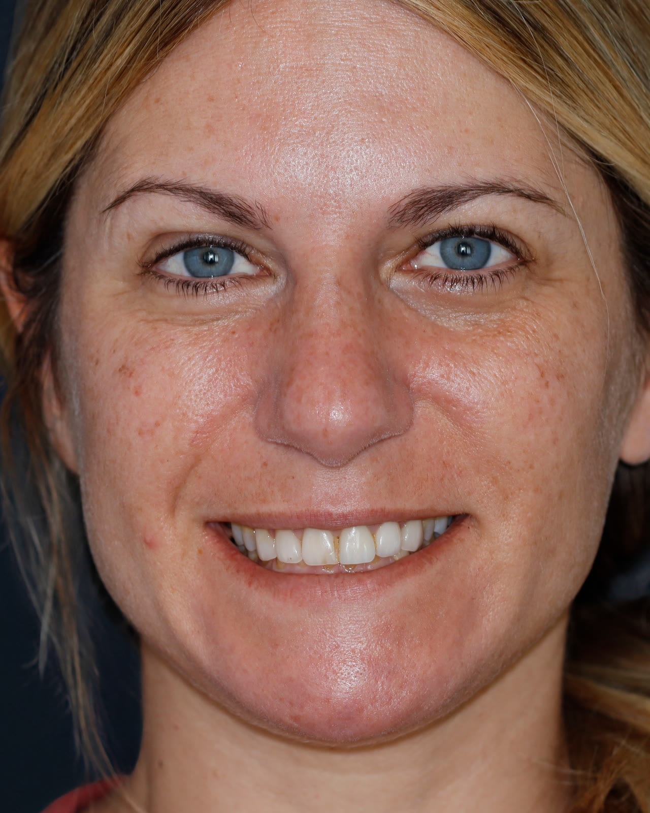 Before full-mouth veneer treatment, front view