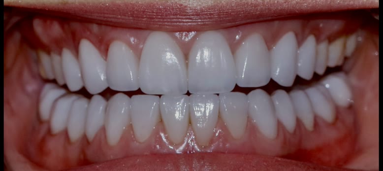 After treatment, retracted close view of the completed restorations