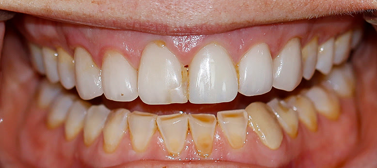 Before treatment, retracted close view of the worn dentition