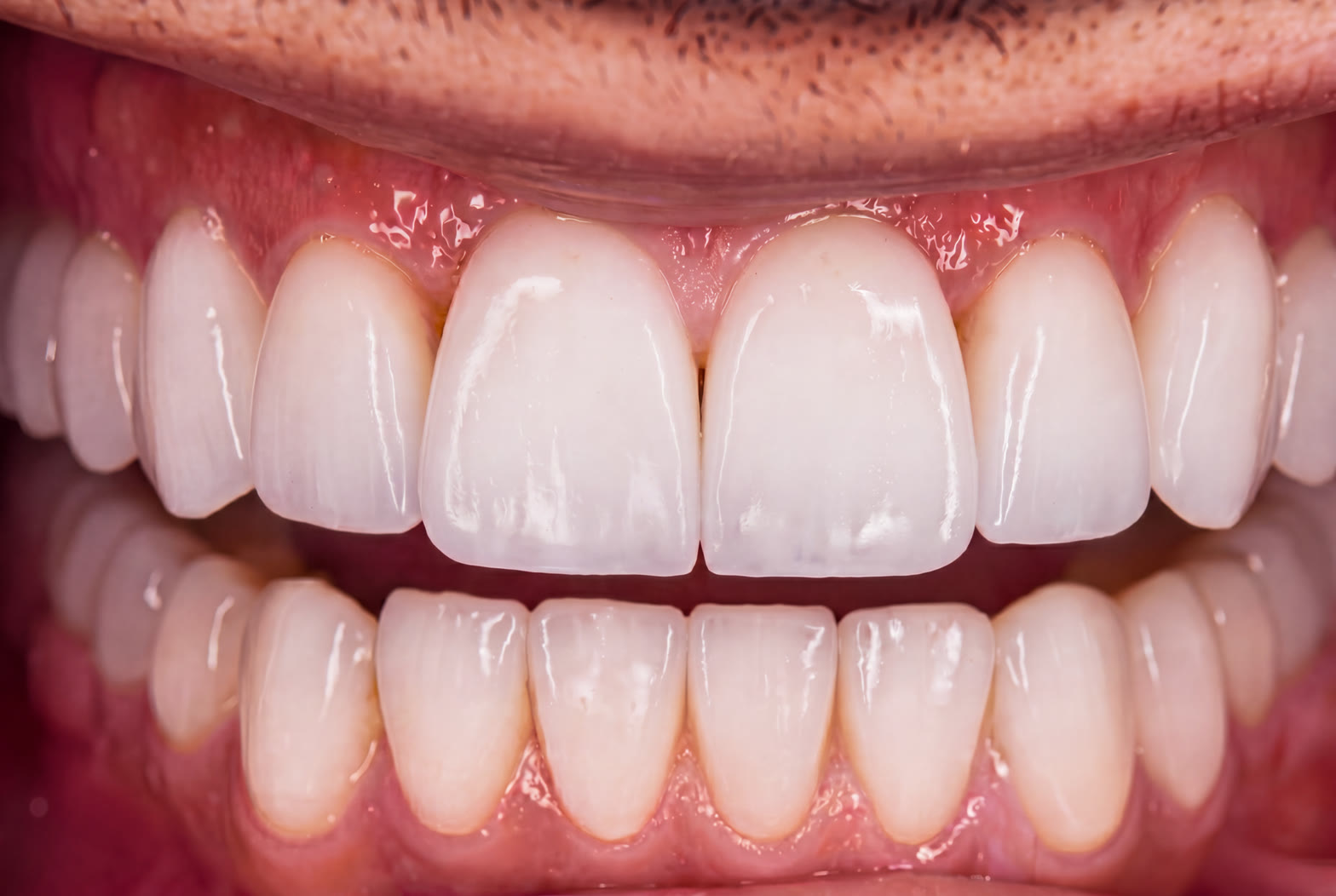 After treatment, close view of the completed ceramic restorations
