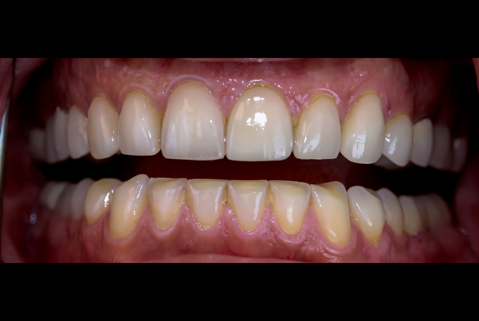 Before treatment, retracted close view showing worn teeth and inflamed gingival margins