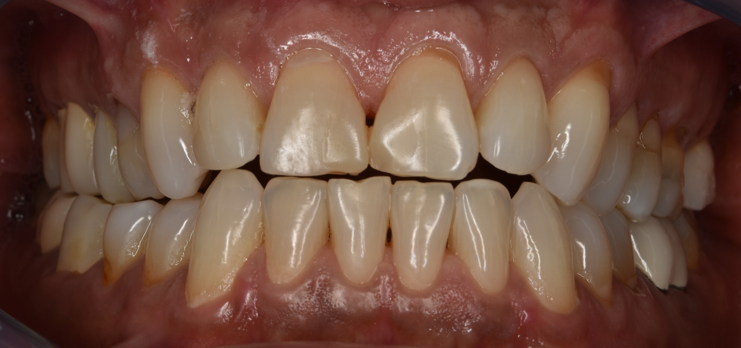 Before treatment, retracted intraoral view of the upper and lower teeth