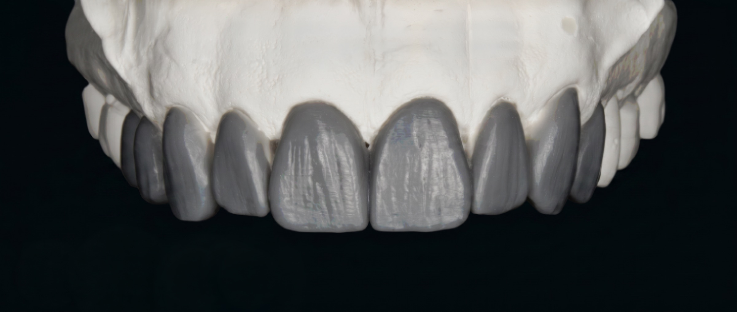 Diagnostic wax-up showing the planned upper anterior veneer contours
