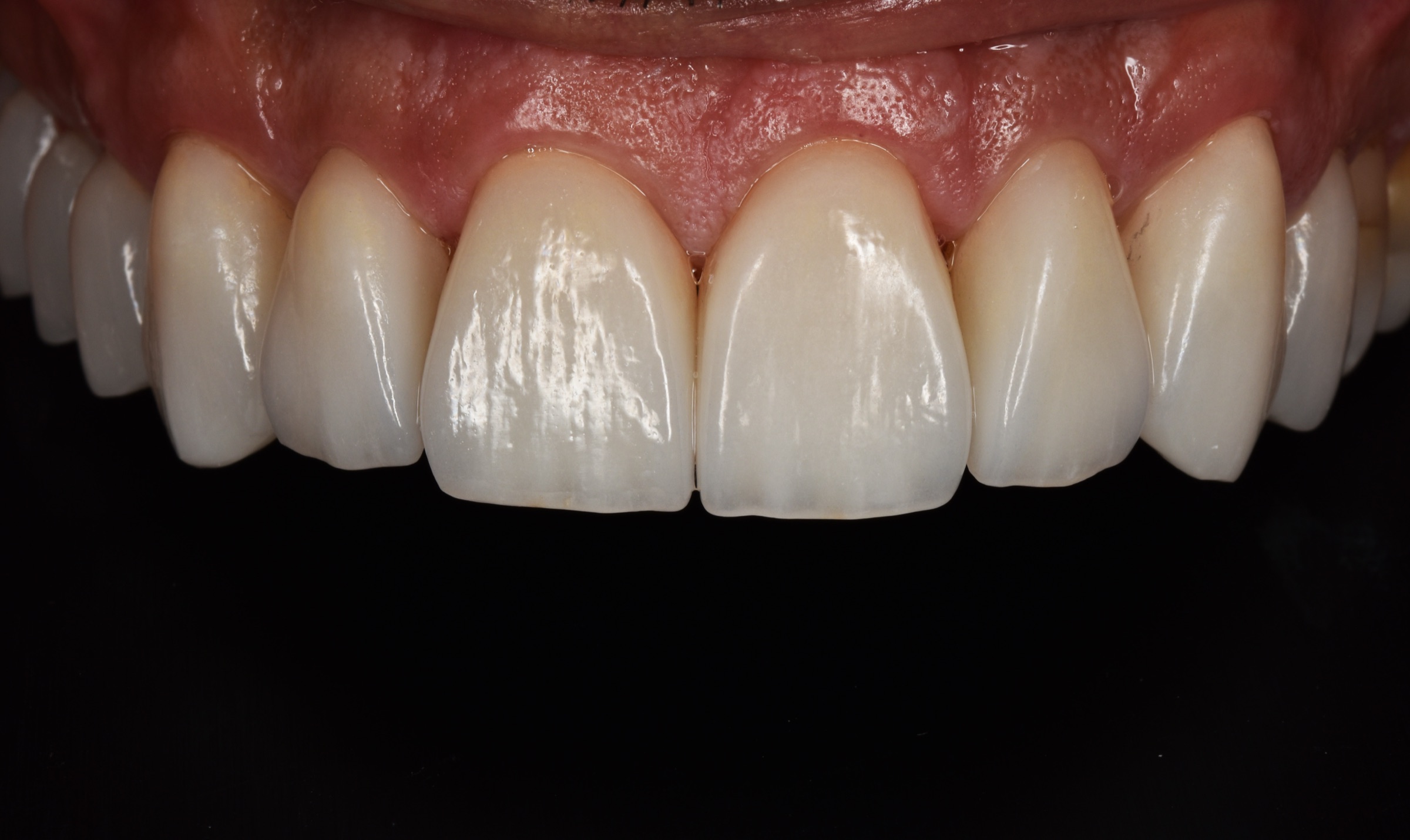 Close-up detail of the completed porcelain veneers