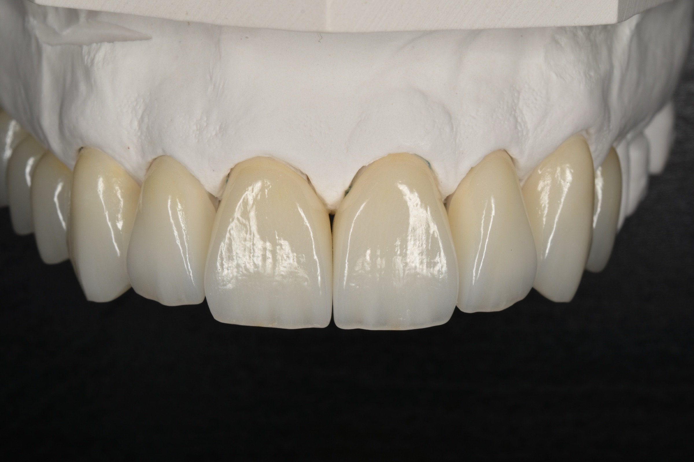 Completed porcelain veneers displayed on the cast