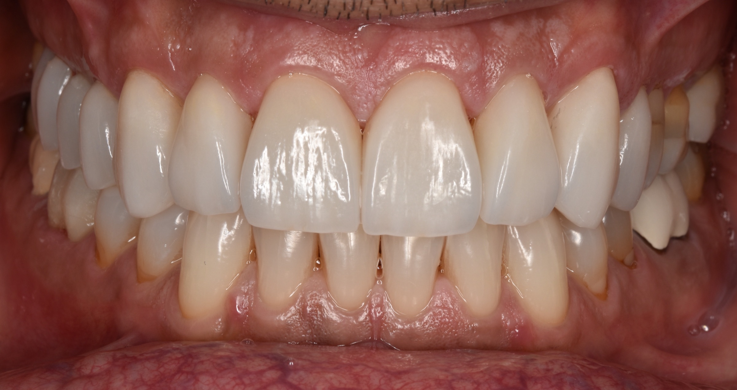 Final retracted intraoral view after porcelain veneer treatment