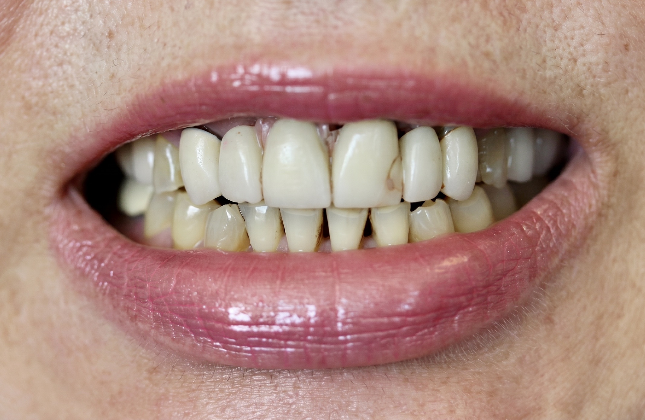 Before treatment, close-up smile with the existing upper anterior restoration
