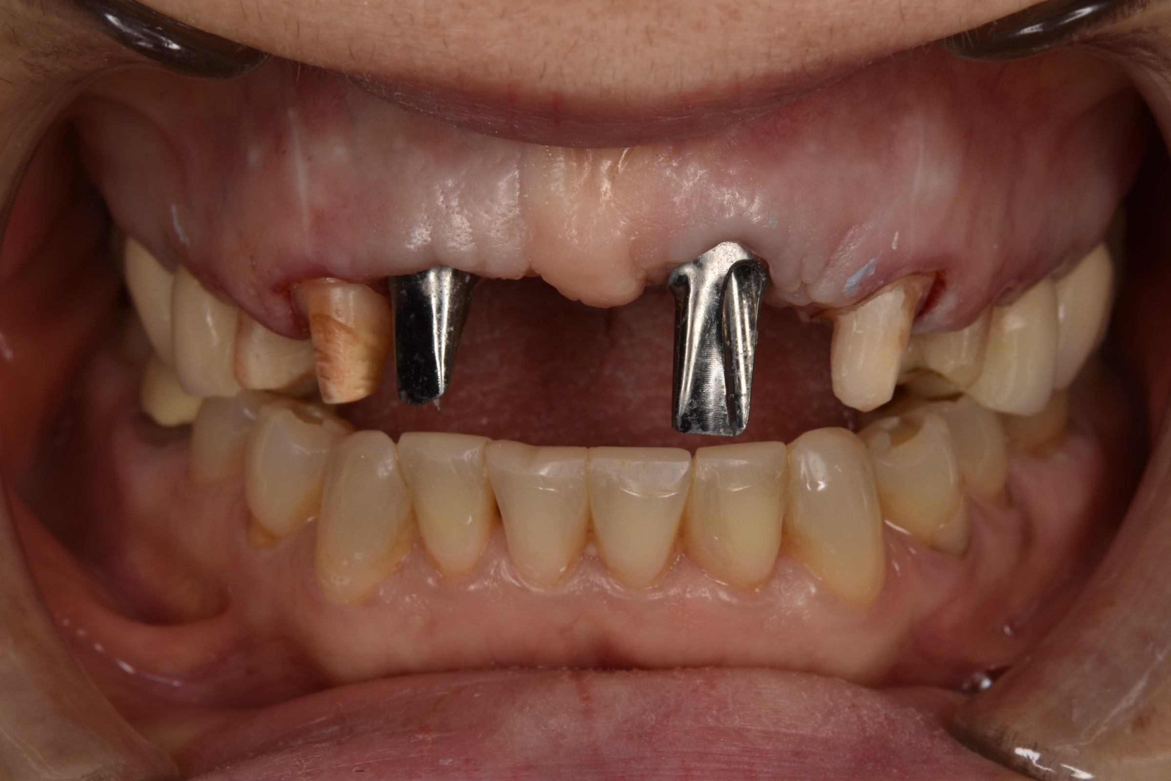 Clinical stage after removal of the existing upper anterior bridge