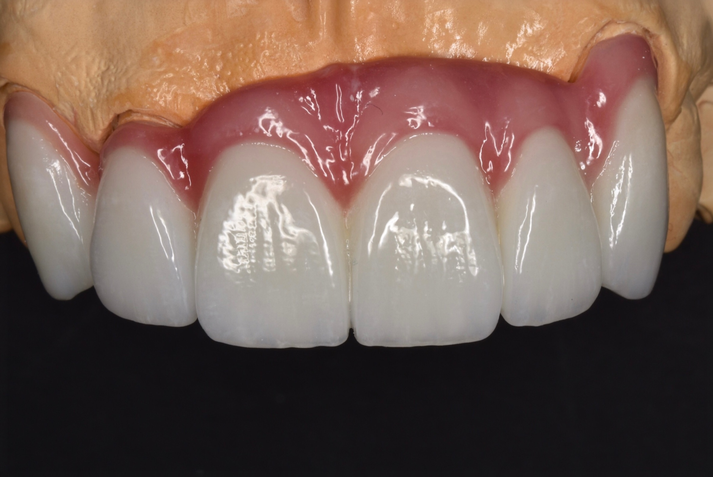 Frontal cast view of the completed upper anterior restoration with pink porcelain