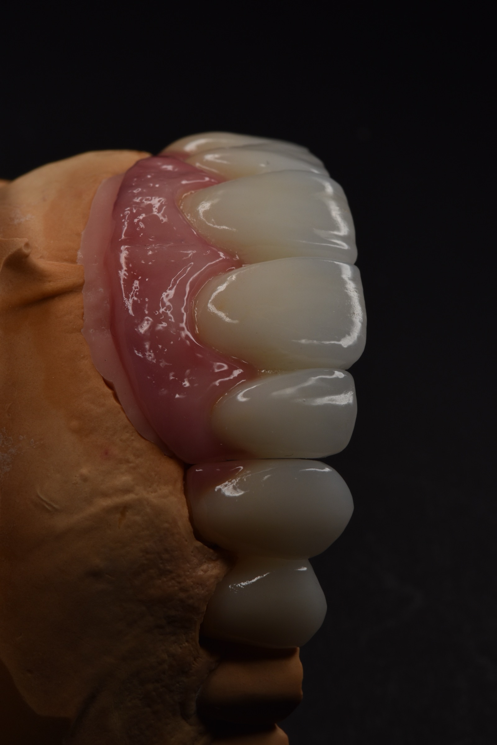 First oblique cast view of the completed upper anterior restoration
