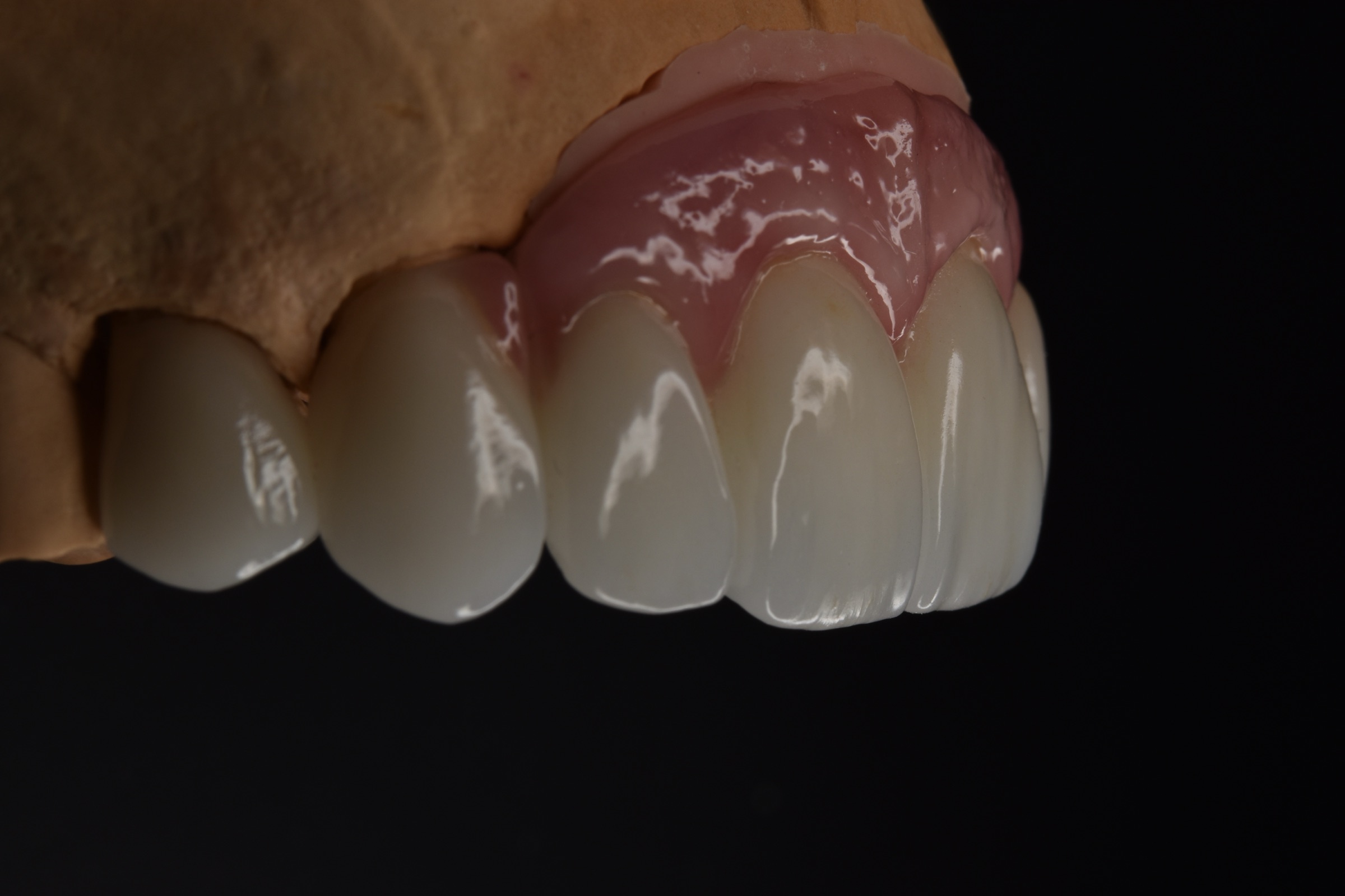 Second oblique cast view of the completed upper anterior restoration