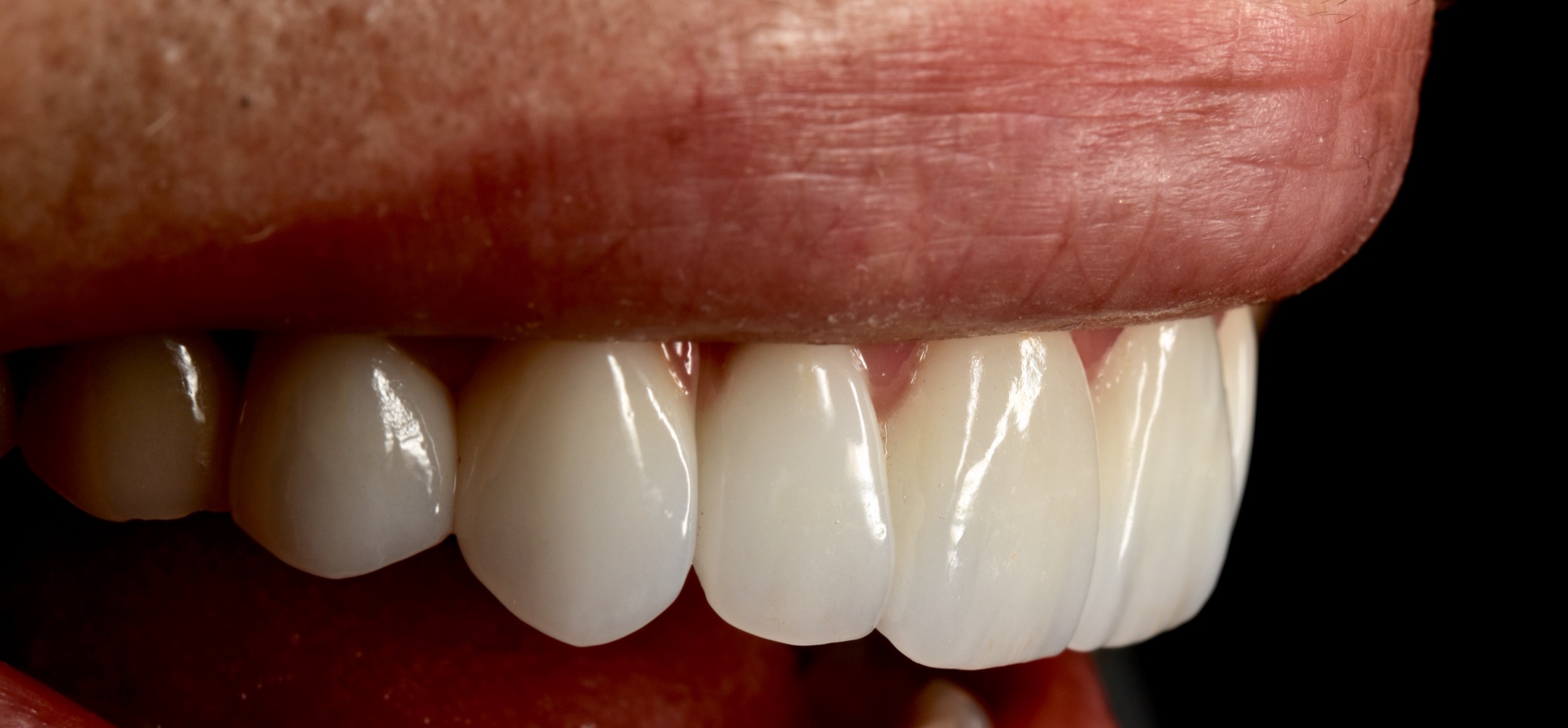 Oblique intraoral detail of the final upper anterior restoration