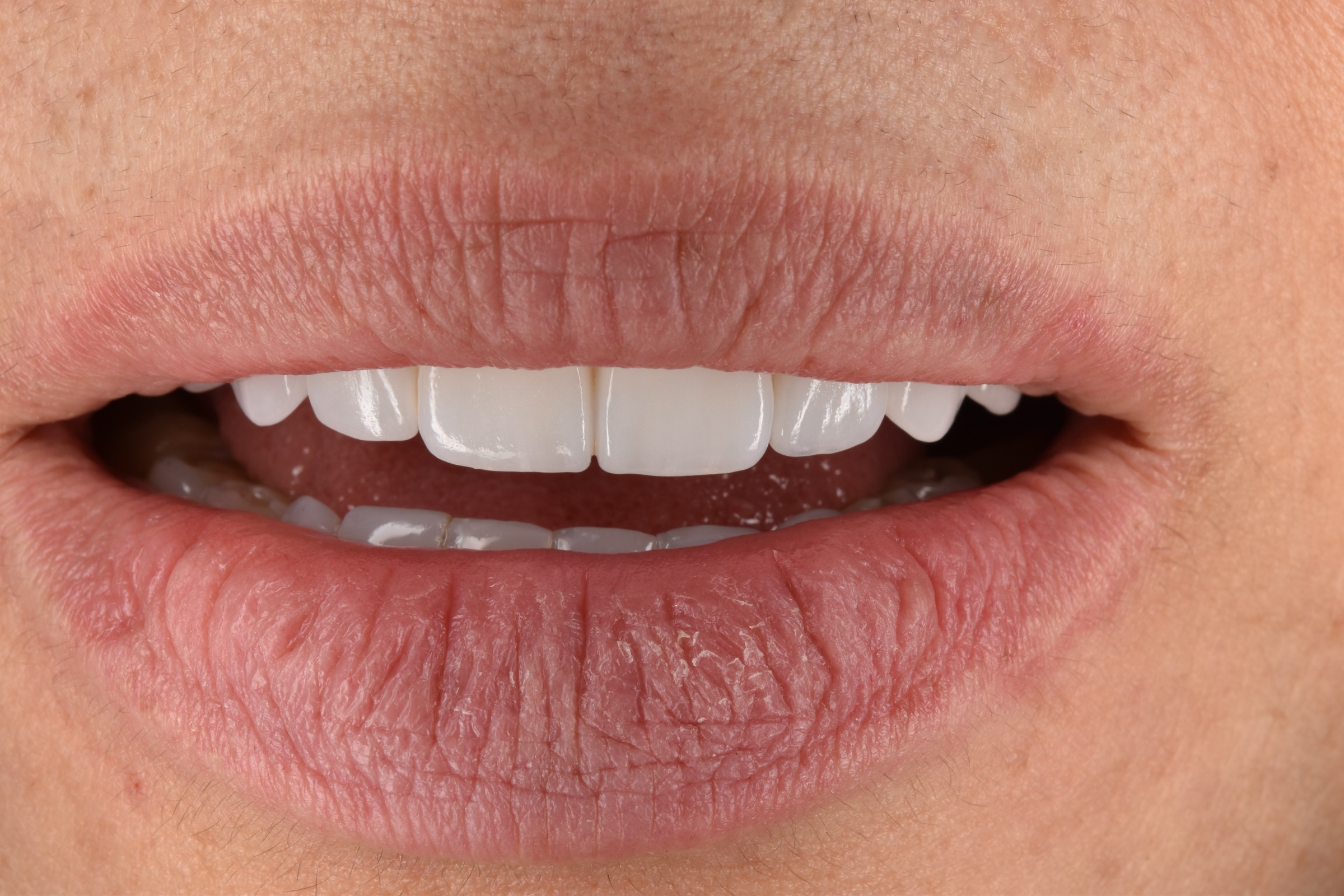 Final close-up smile after completion of the upper anterior bridge