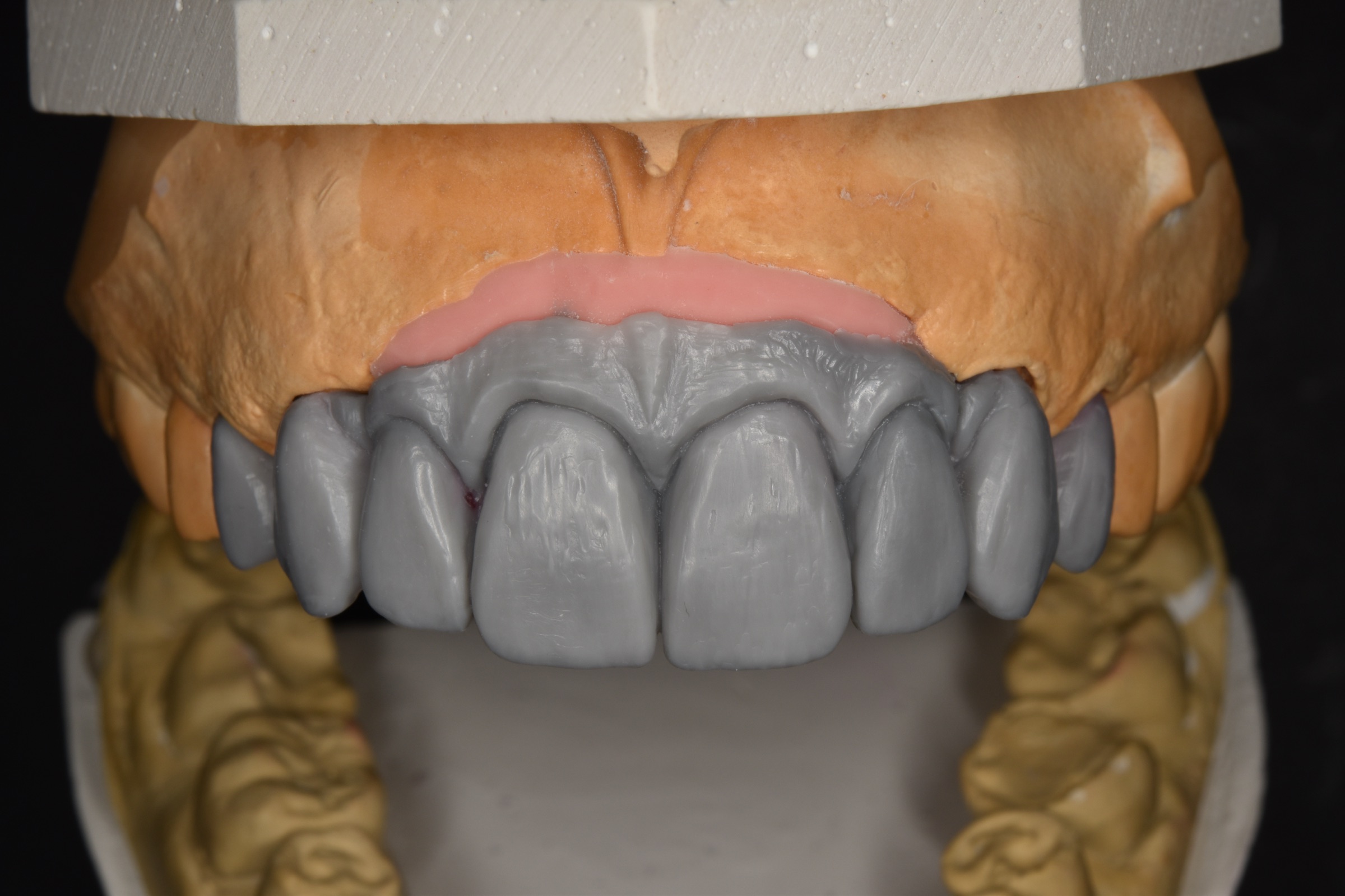 Frontal view of the diagnostic wax-up for the upper anterior bridge