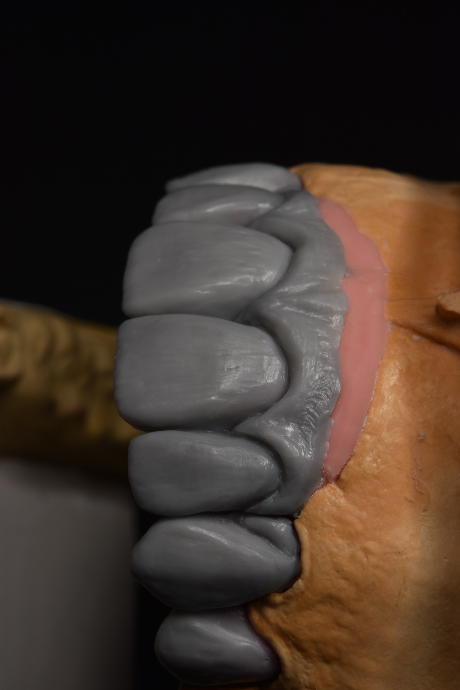 Second oblique view of the diagnostic wax-up