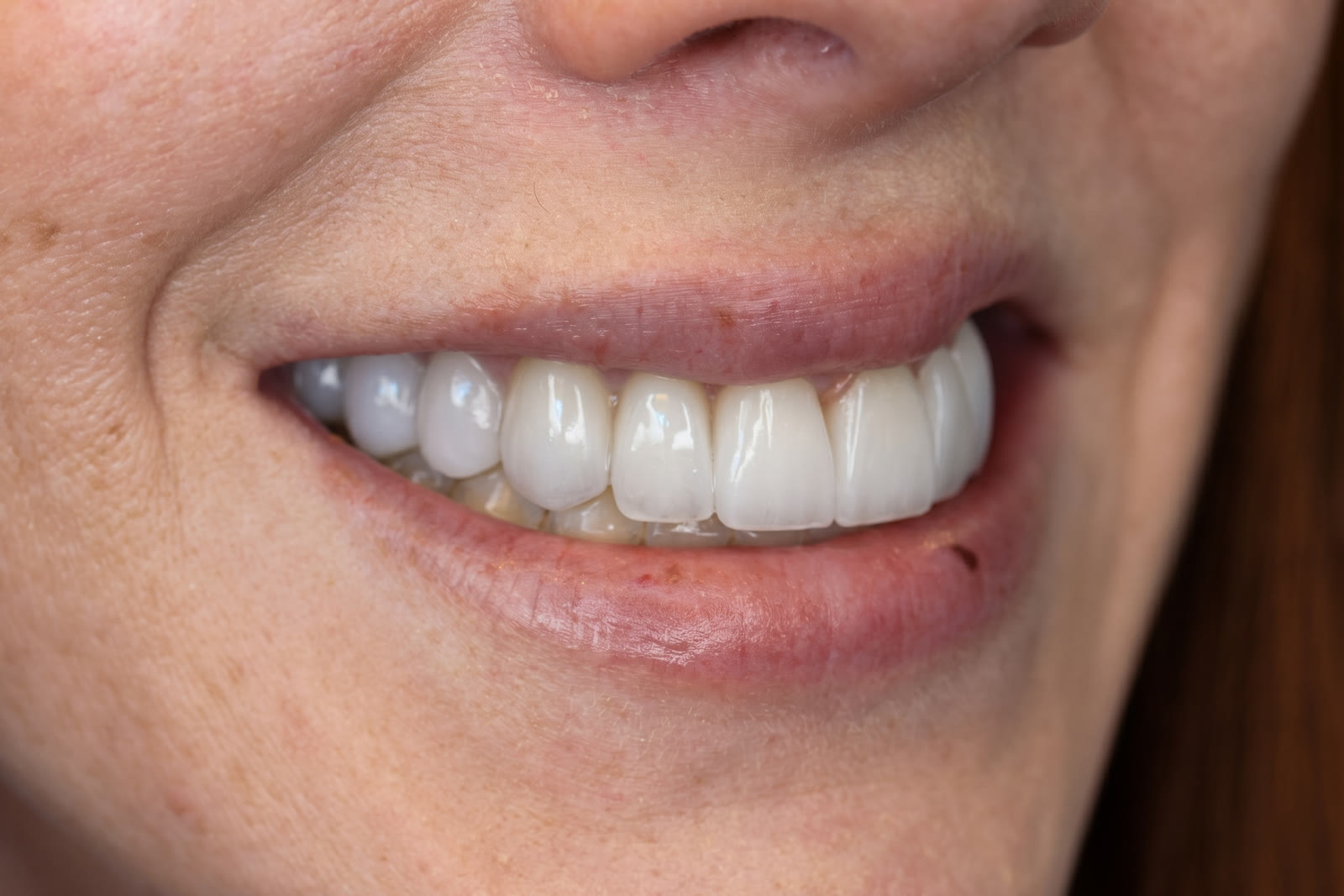 After upper arch crown rehabilitation, three-quarter view