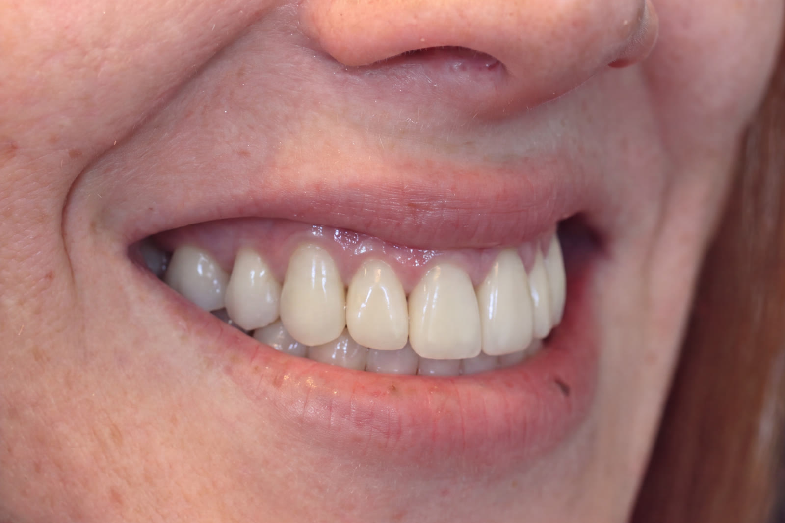 Before upper arch crown rehabilitation, three-quarter view