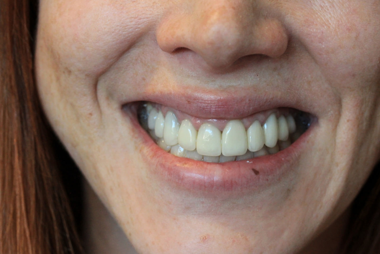 Before upper arch crown rehabilitation, close view showing elevated gingival display