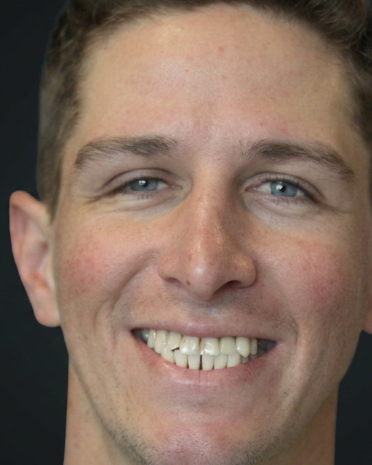 Before treatment, full-face frontal smile