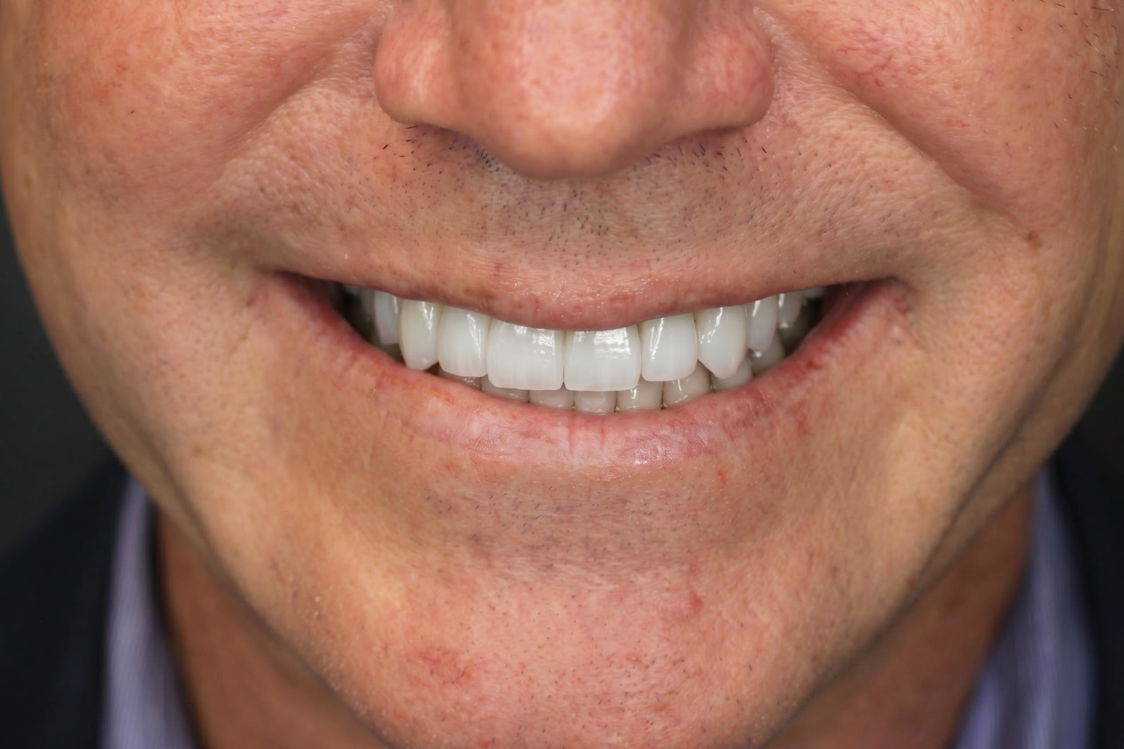 After upper veneer treatment, close view of the completed veneers