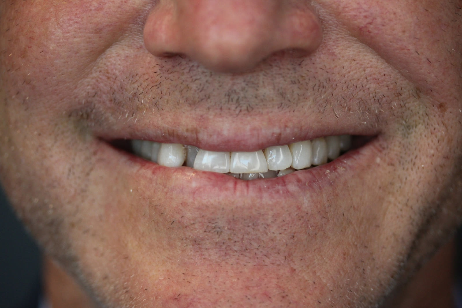 Before upper veneer treatment, close view of worn and uneven upper teeth