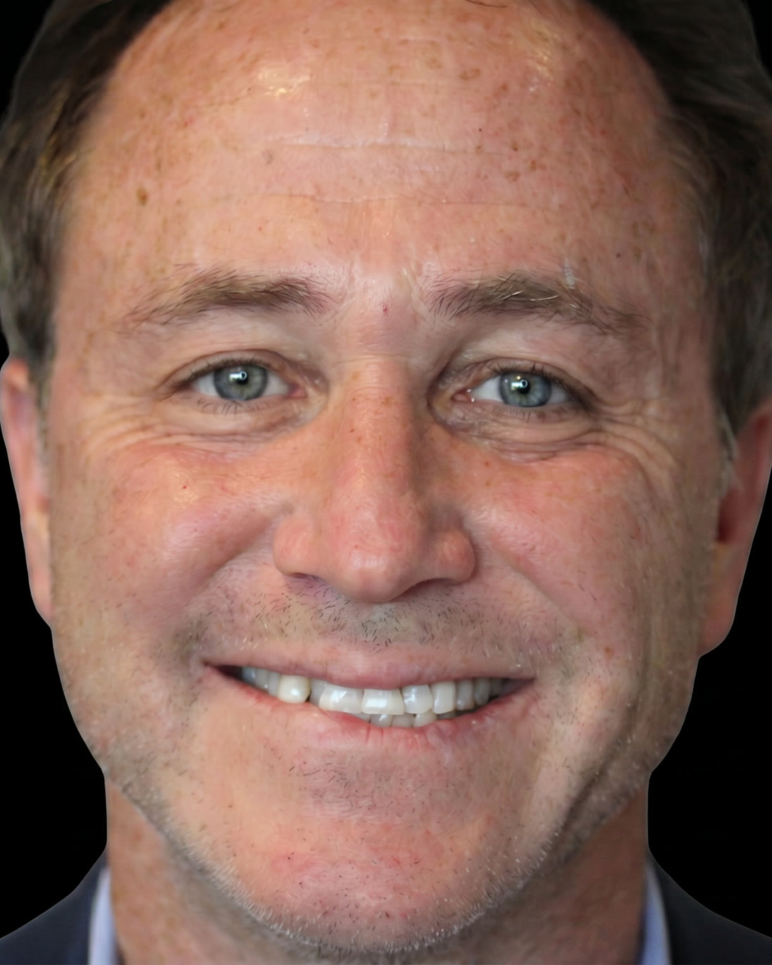 Before upper veneer treatment, front view